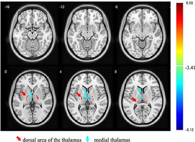 The Medial Thalamus Plays an Important Role in the Cognitive and Emotional Modulation of Orofacial Pain: A Functional Magnetic Resonance Imaging-Based Study